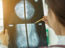 lakare-ser-mammografibild